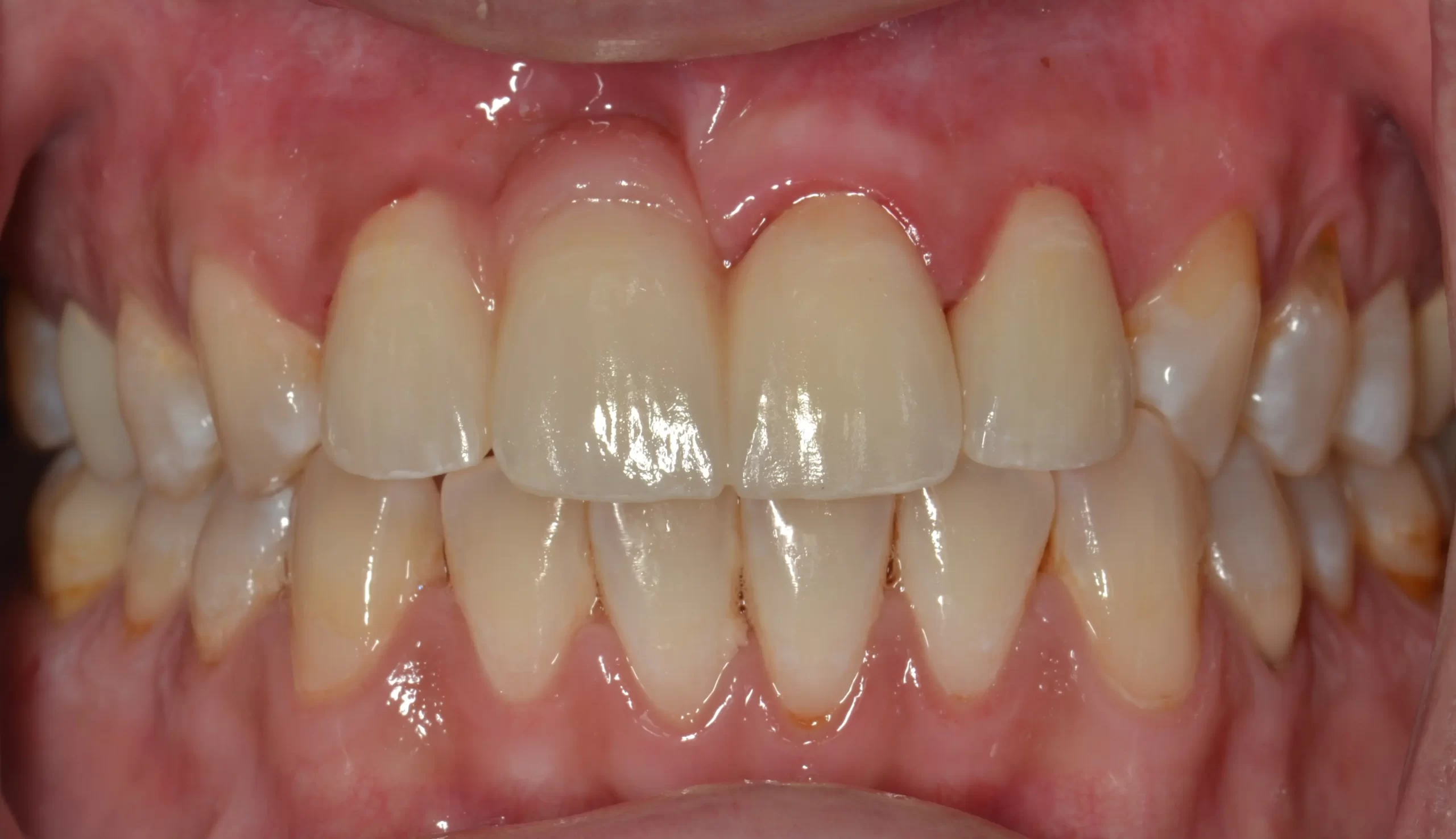 Smile after dental implant tooth replacement and gum recontouring