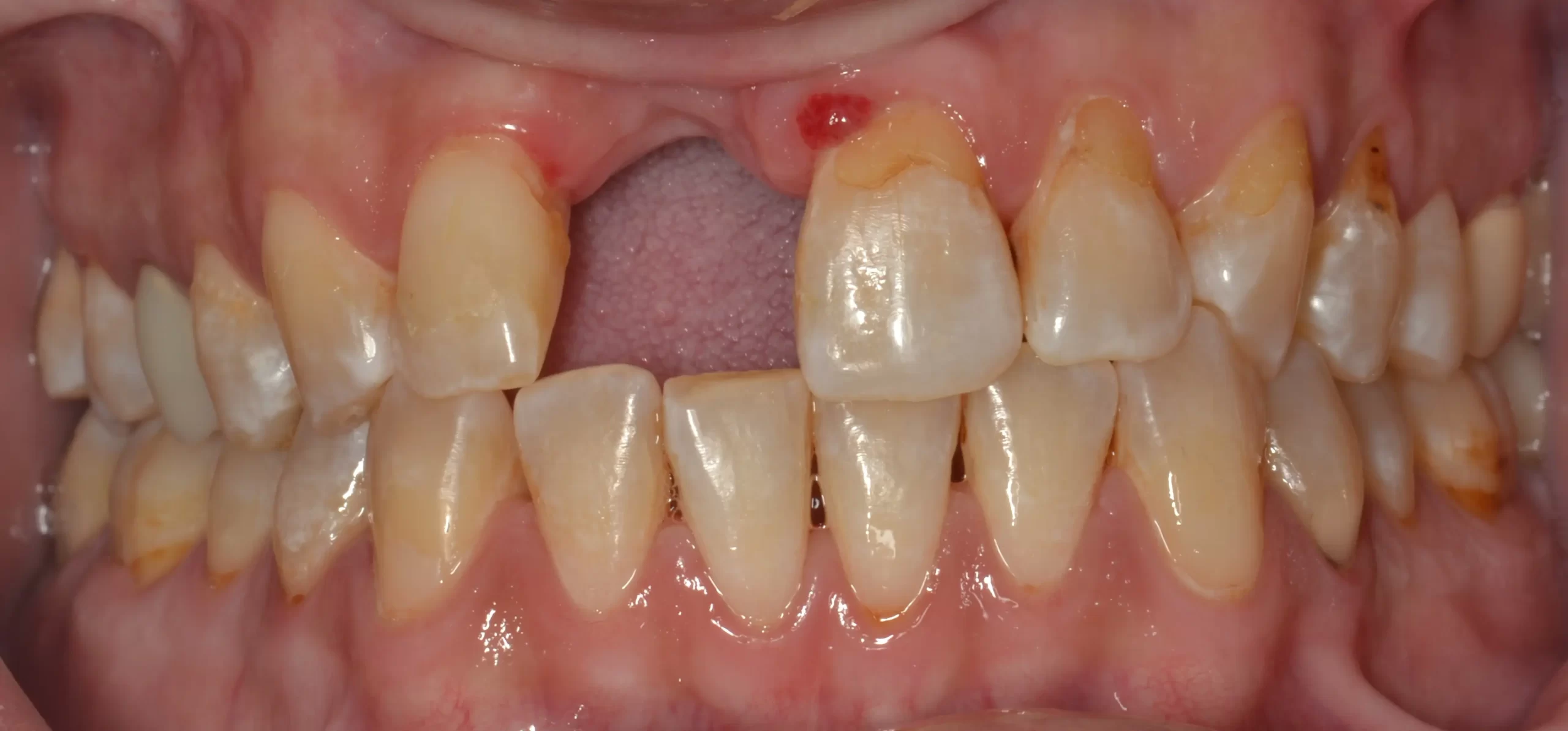 Smile before dental implant tooth replacement