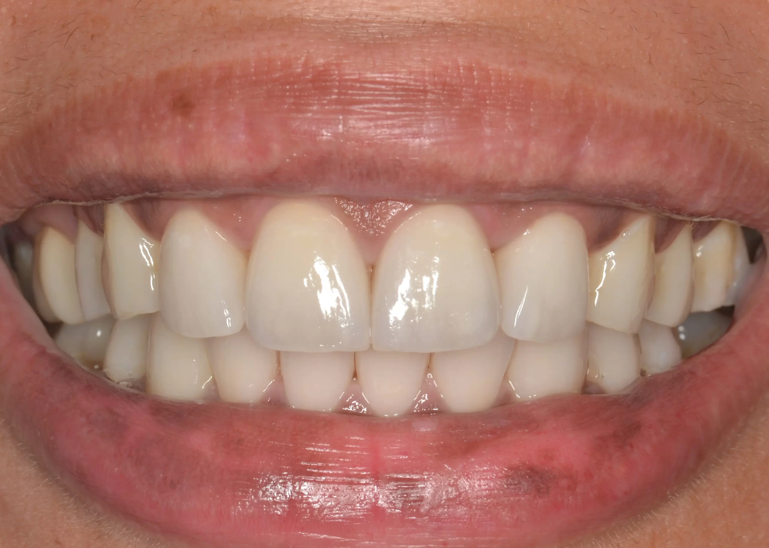 Patient smiling after porcelain veneers at Coastline Dental Care