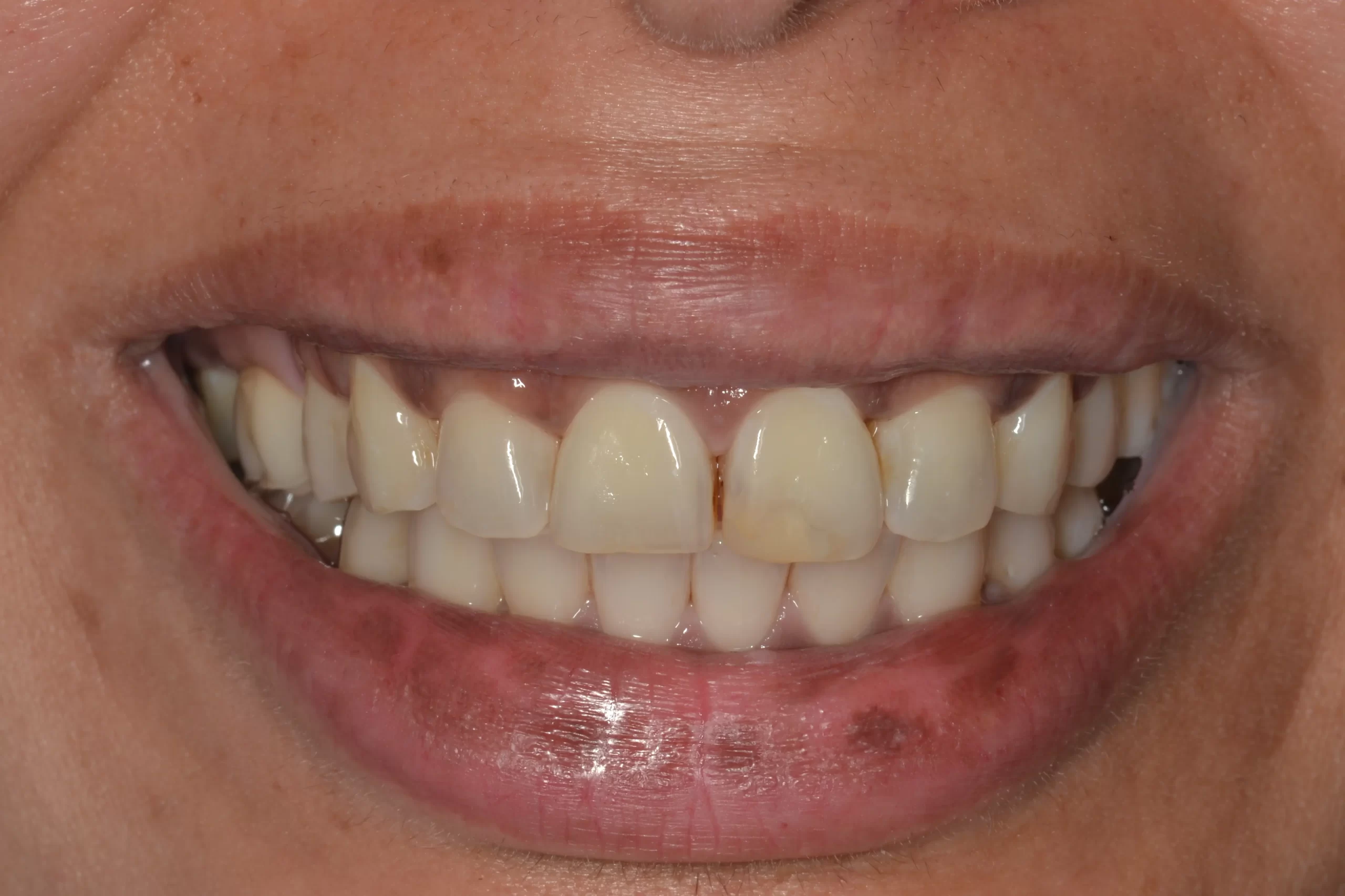 Patient teeth before porcelain veneers at Coastline Dental Care