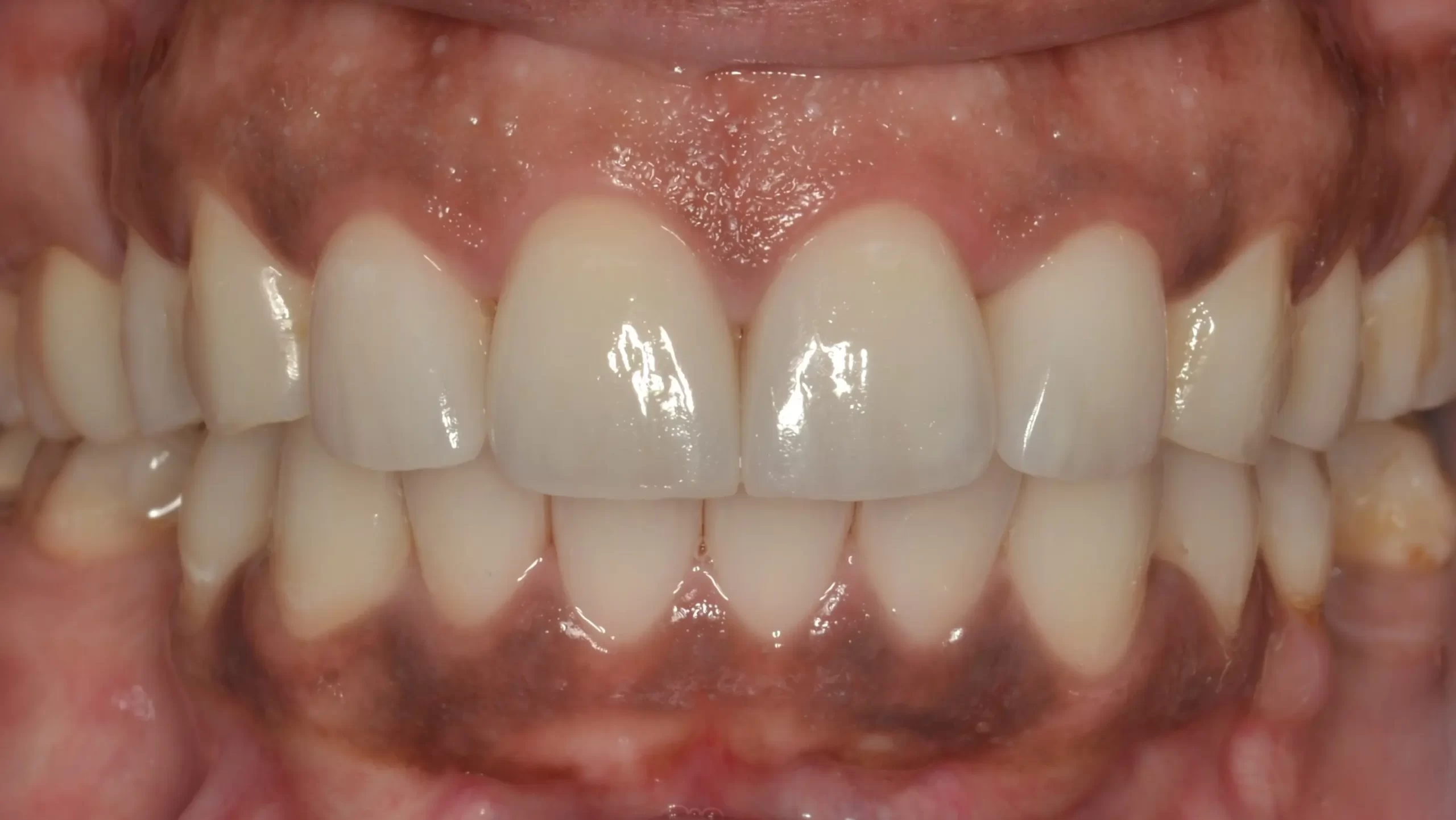 Final porcelain veneers bonded in place at Coastline Dental Care