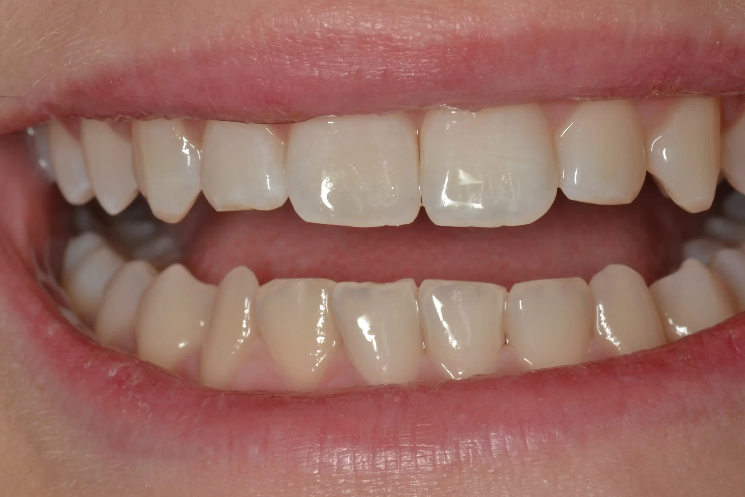 Front teeth after Icon white spot treatment