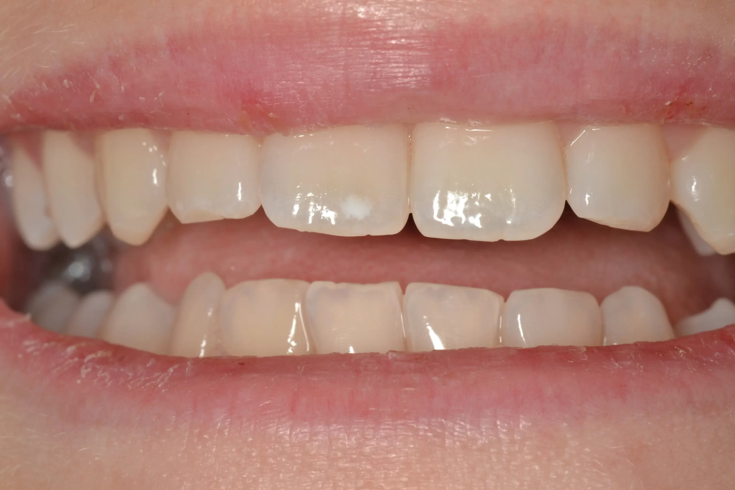 Front teeth with white spots before Icon treatment