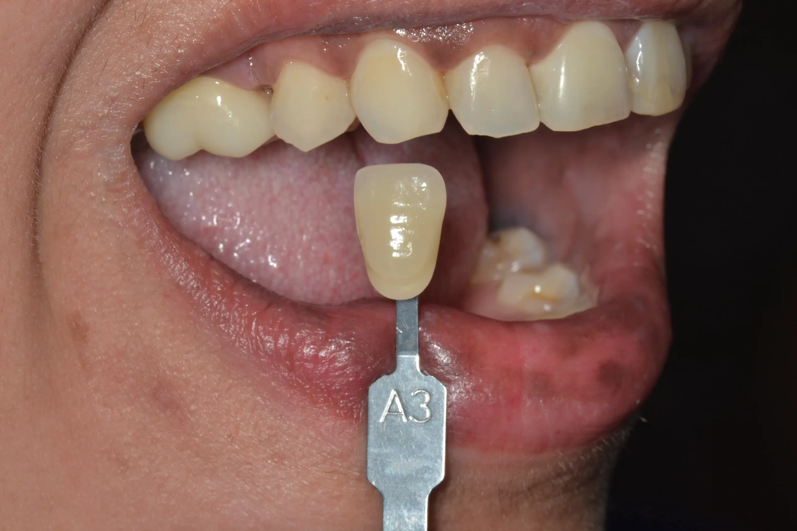Shade guide held next to the patient teeth to match veneer color