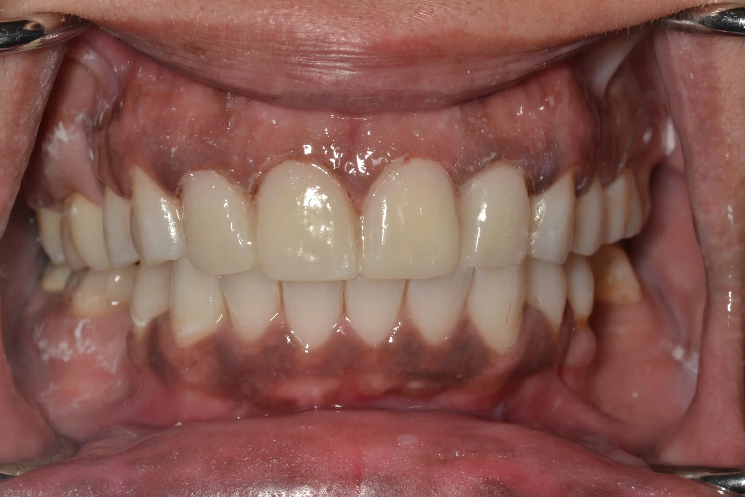 Temporary veneers in place while the final porcelain veneers are made